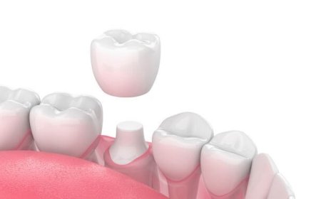 What to Expect When Living with a Temporary Crown on Your Teeth