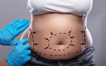 What to Expect From Liposuction and Why It’s Worth Considering