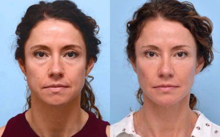 How the Best Plastic Surgeon in Dubai Combines Thread Lift with Other Non-Surgical Treatments