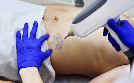 What to Expect from Laser Tattoo Removal for Smooth Skin Again