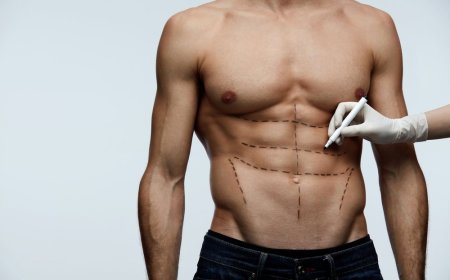 Vaser 4D Liposuction Benefits for Stubborn Fat and Shaping