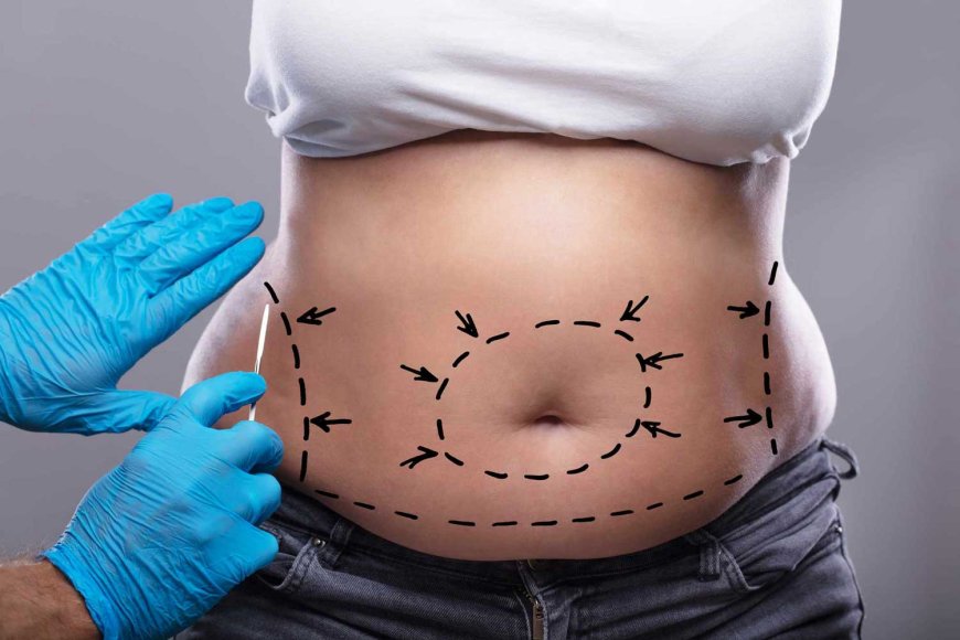 What to Expect From Liposuction and Why It’s Worth Considering