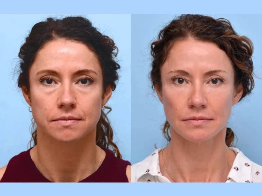 How the Best Plastic Surgeon in Dubai Combines Thread Lift with Other Non-Surgical Treatments