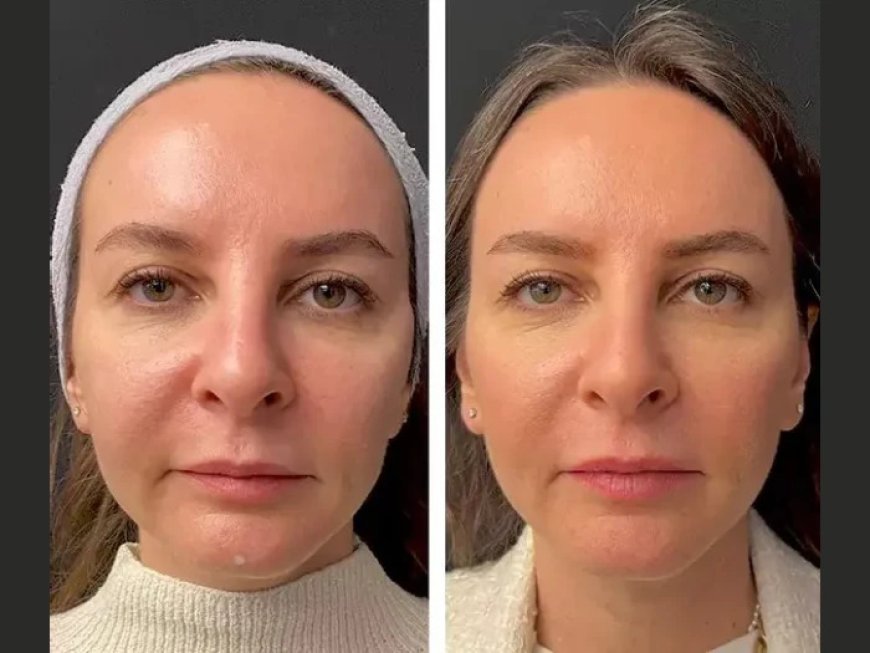 Mesotherapy for Acne Scars: Insights from the Best Plastic Surgeon in Dubai