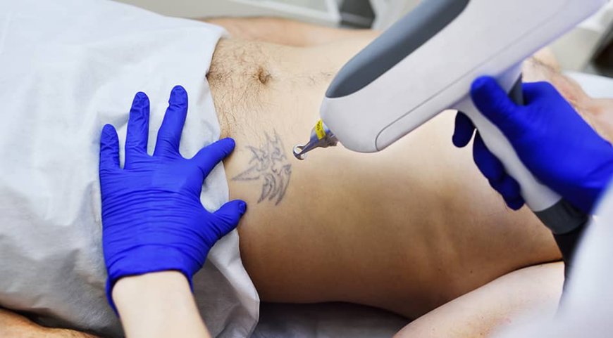 What to Expect from Laser Tattoo Removal for Smooth Skin Again