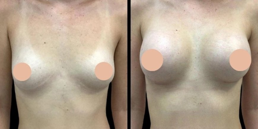 How Long Will the Results Last Insights from the Best Breast Augmentation Surgeons in Dubai