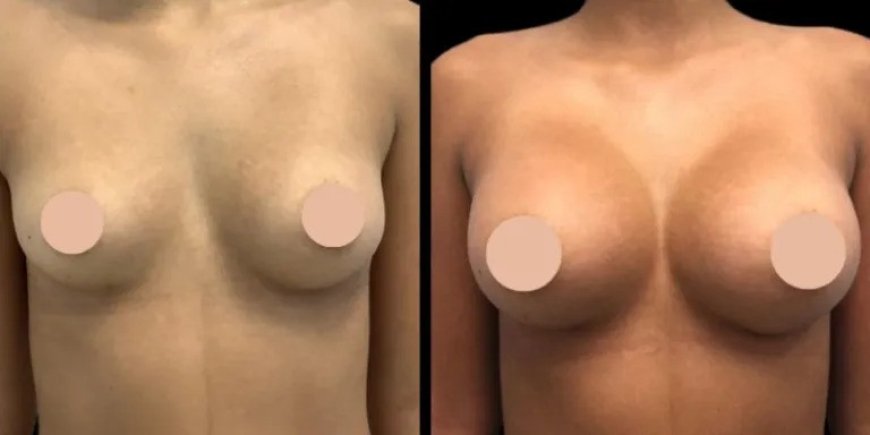 Breast Augmentation in Dubai: Understanding Costs and Financing Options