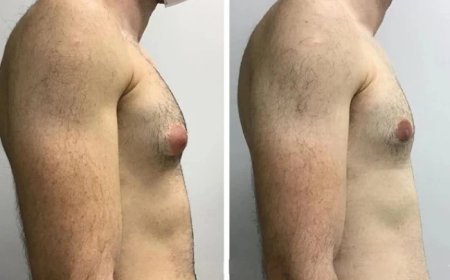Understanding the Costs and Benefits of Gynecomastia Surgery in dubai with the Best Surgeons