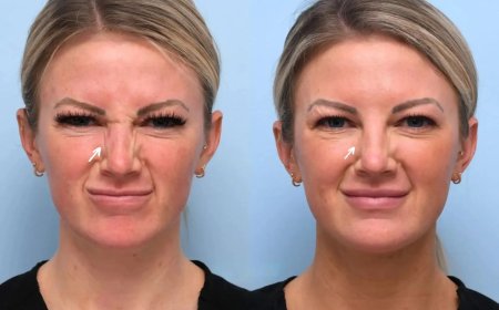 Botox Treatment in Dubai: Everything You Need to Know Before Getting Started