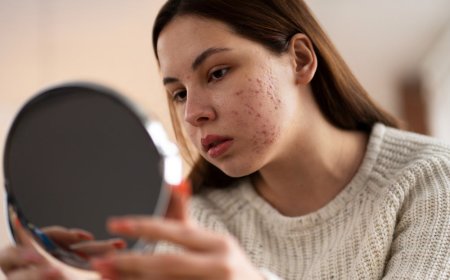 How Acne Treatment Transforms Confidence and Clears Skin