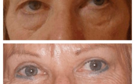 Understanding Eye Anatomy for Better Results: Advice from the Best Eye bag removal Surgeons in Dubai