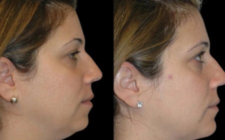 Best Double chin removal Surgeons in Dubai Reveal Most Requested Looks