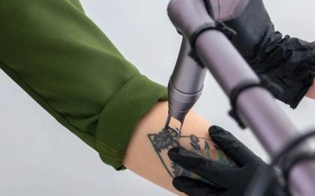 Laser Tattoo Removal Made Easy for Fast and Visible Ink Reduction