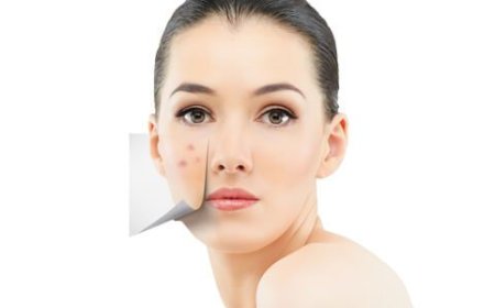 Acne Treatment That Clears Skin Without Dryness or Irritation