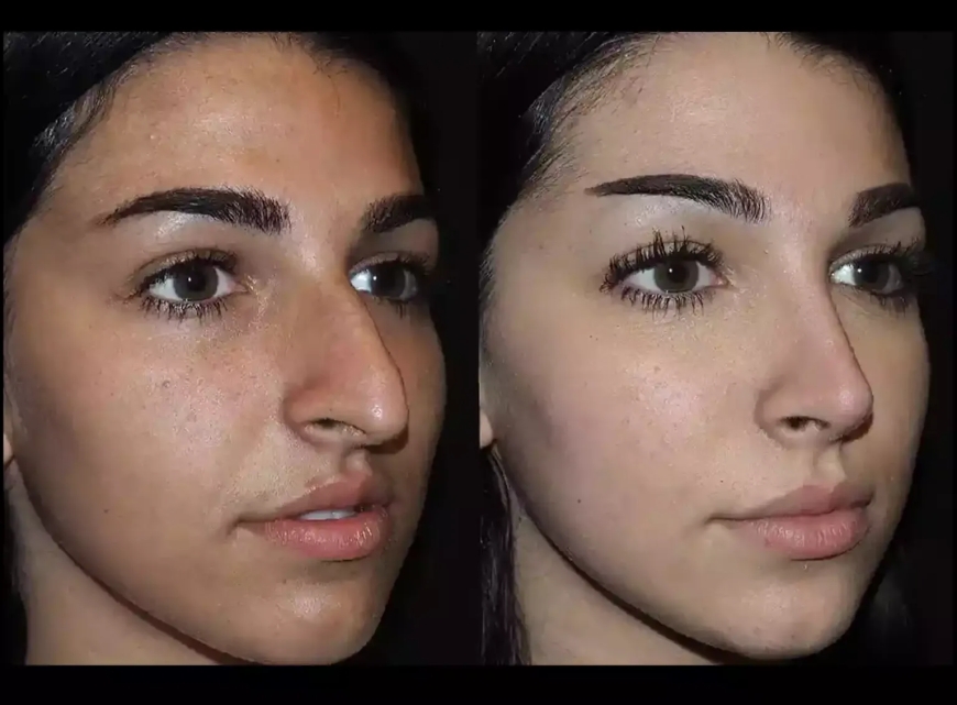 Your Complete Guide to Rhinoplasty in Dubai