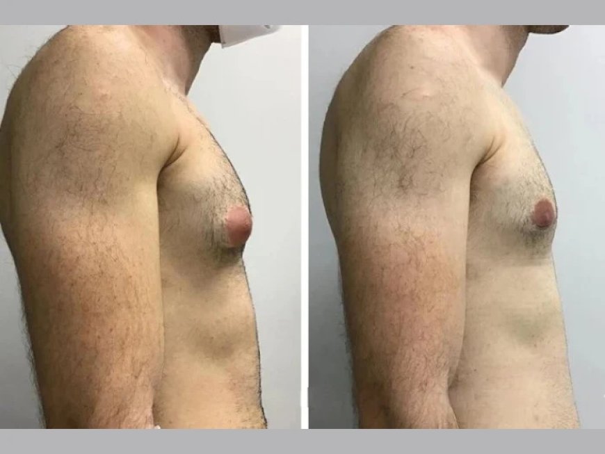 Understanding the Costs and Benefits of Gynecomastia Surgery in dubai with the Best Surgeons
