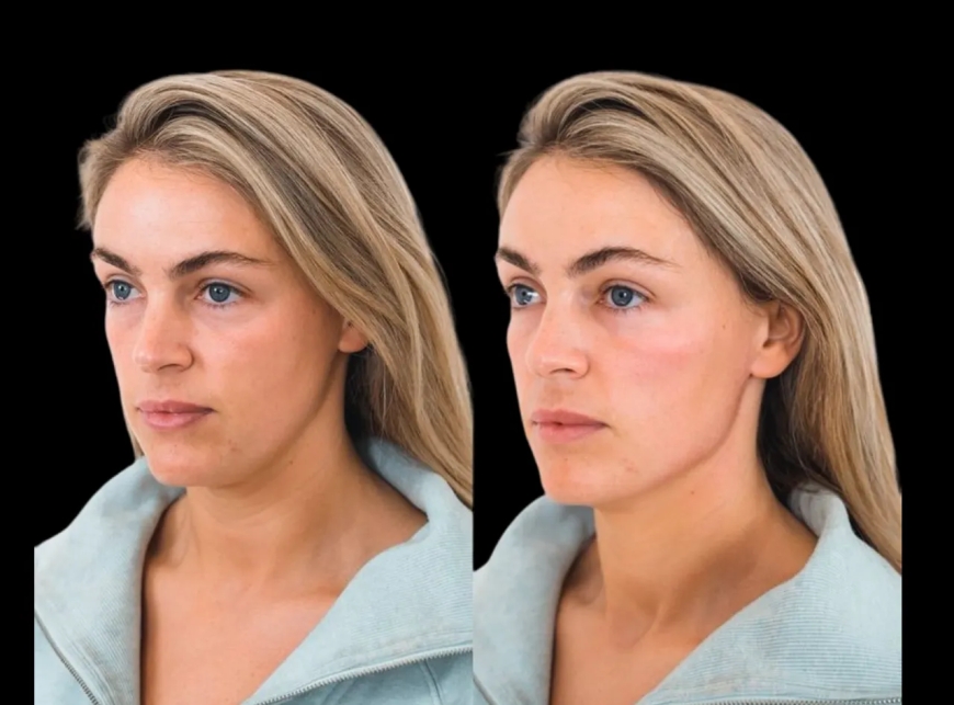 The Top 5 Best Aesthetic Clinics in Dubai for Cheek Fillers Facelift Alternatives