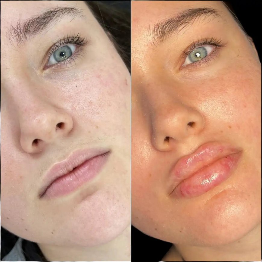 The Best Aesthetic Clinics in Dubai and Their Approach to Russian Lip Fillers Injection