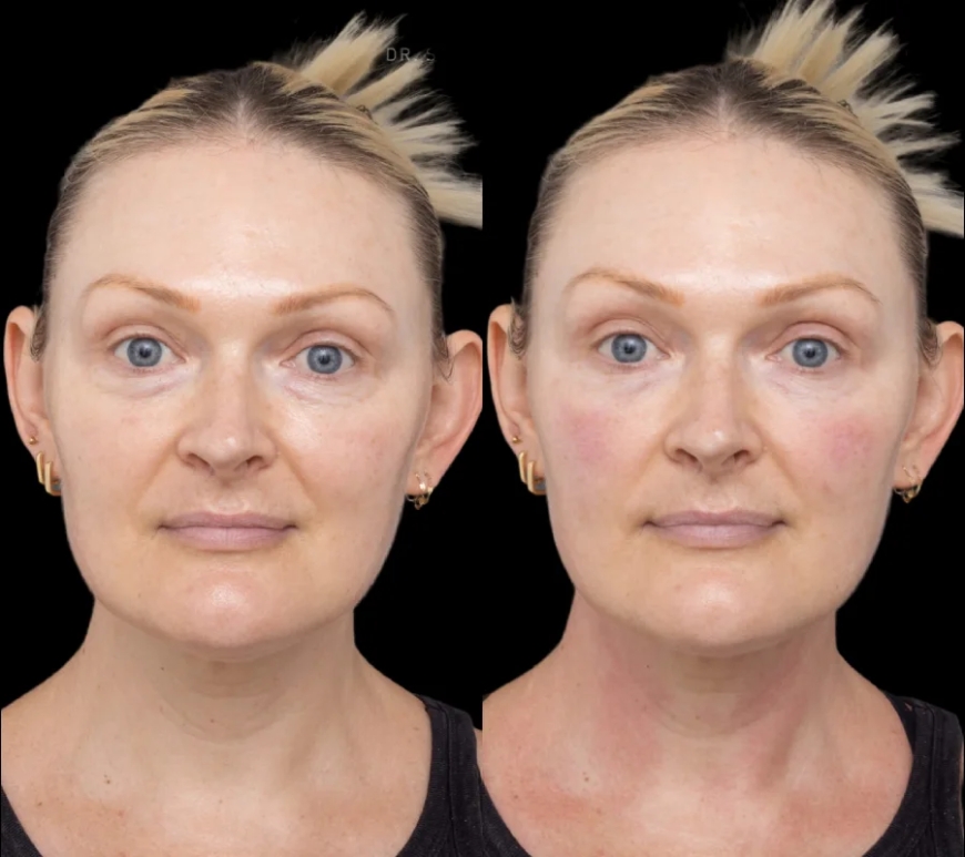 The Significance of Skilled Doctors in Under Eye Fillers at the Best Aesthetic Clinics in Dubai