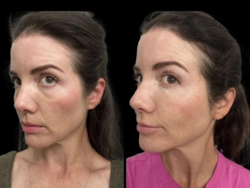 Dark Circles Treatment in Dubai: A Guide to Popular Clinic Options