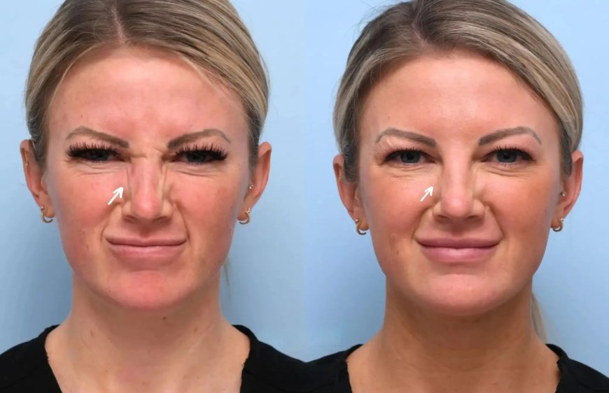 Botox Treatment in Dubai: Everything You Need to Know Before Getting Started