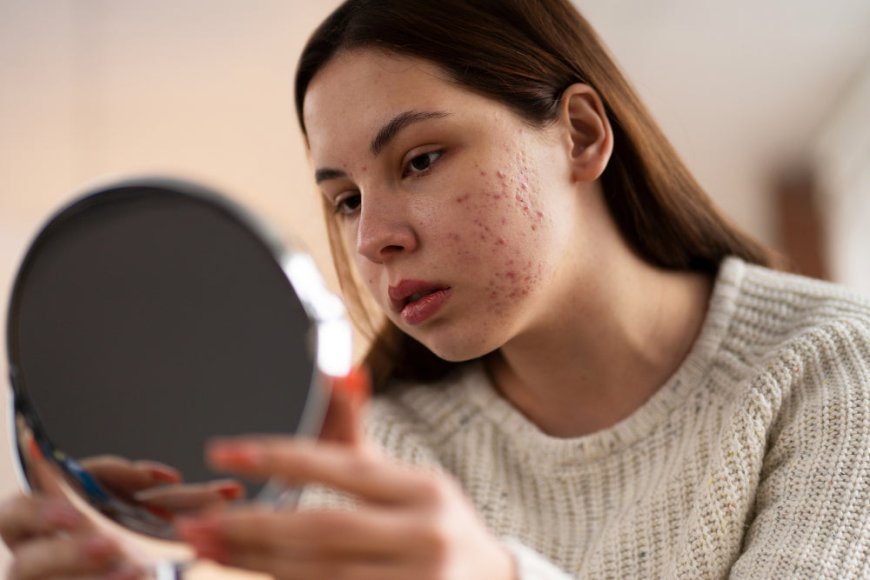How Acne Treatment Transforms Confidence and Clears Skin