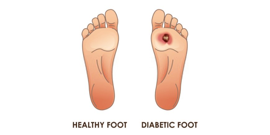 Challenges and Opportunities in the Diabetic Foot Ulcer Market