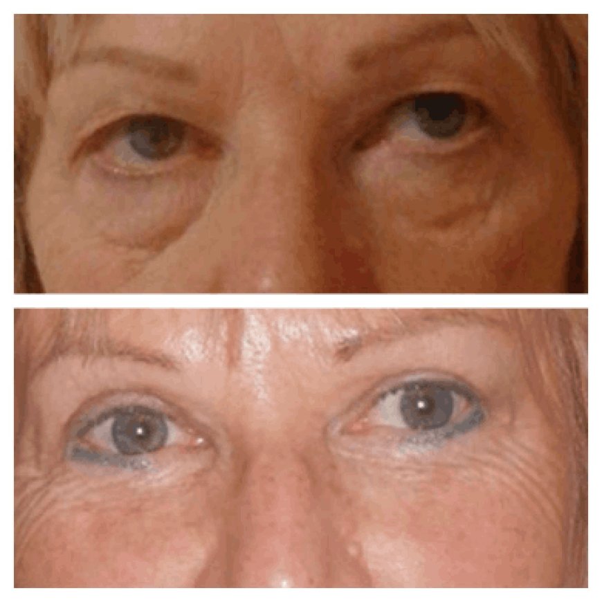 Understanding Eye Anatomy for Better Results: Advice from the Best Eye bag removal Surgeons in Dubai