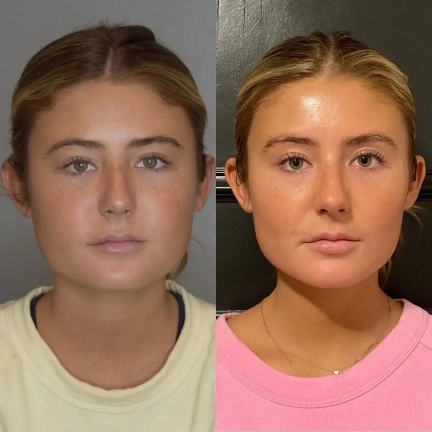 Innovations by the Best Buccal fat removal Surgeons in Dubai