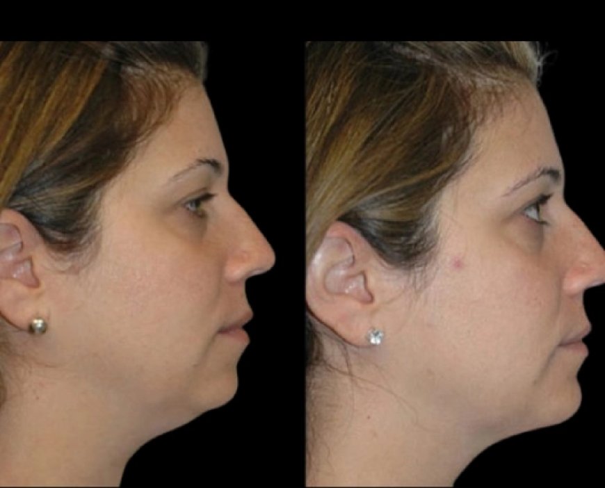 Best Double chin removal Surgeons in Dubai Reveal Most Requested Looks