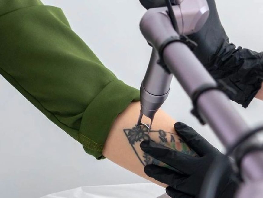 Laser Tattoo Removal Made Easy for Fast and Visible Ink Reduction