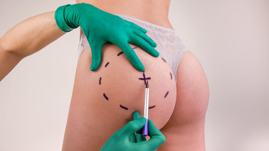Enhance Your Silhouette Easily with Butt and Body Fillers