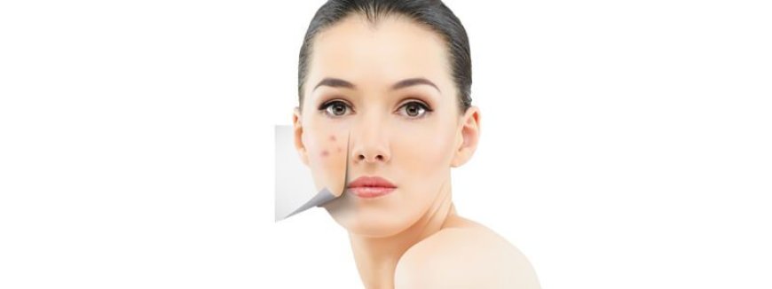 Acne Treatment That Clears Skin Without Dryness or Irritation