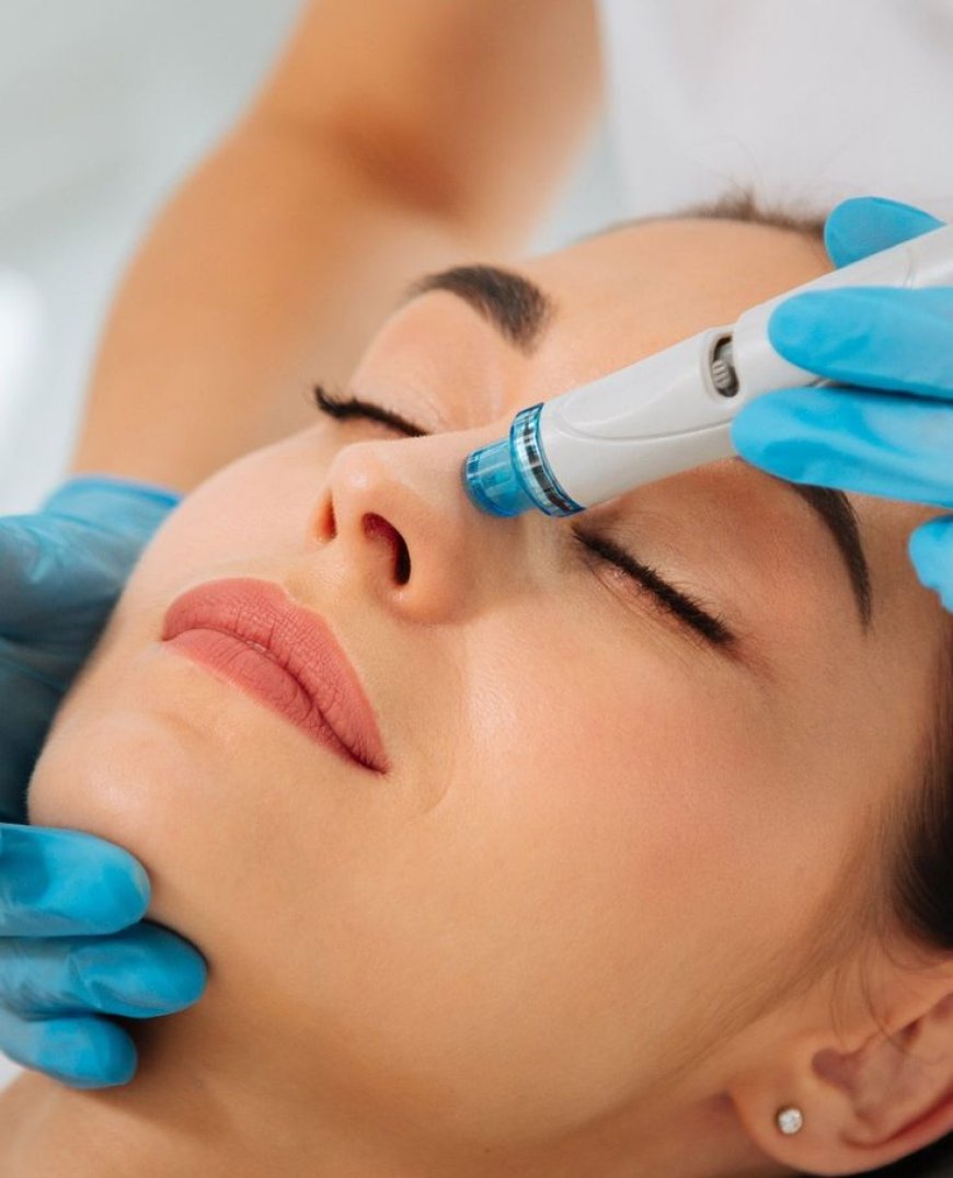 Microneedling Treatment for Face in Chelsea, London — Benefits for Face, Hair, Acne Scars & Stretch Marks