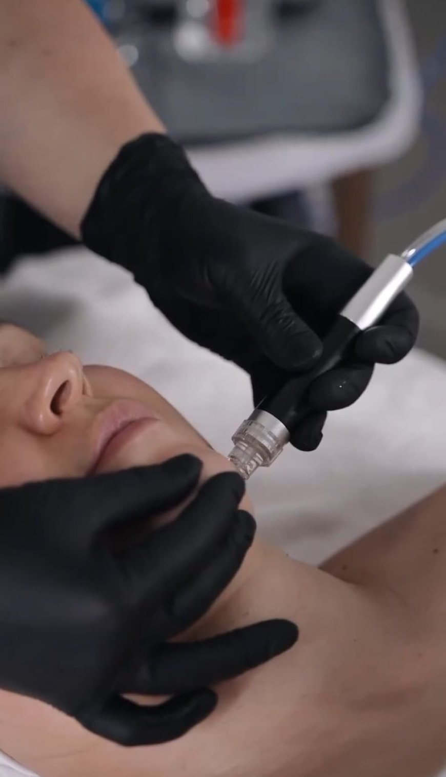 Dermaplaning Facial Chelsea London – Your Complete Guide to Glowing Skin