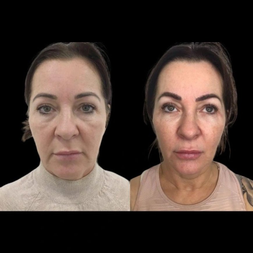 How the Best Plastic Surgeon in Dubai Use Profhilo to Restore Skin Elasticity